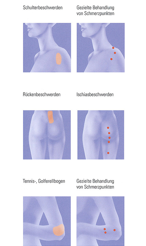 Lasertherapie - Facharzt für Orthopädie,
Chirotherapie & Akupunktur Dr. med. Dimitrios Pappas in 44787 Bochum